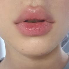 Popular Lip Filler Shapes: Bow-Shaped Lips