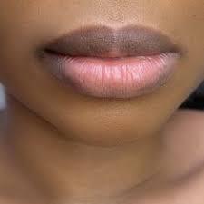 Popular Lip Filler Shapes: Natural Plump
