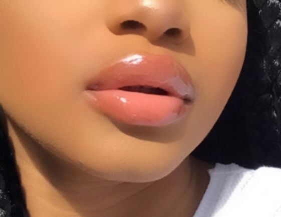 Popular Lip Filler Shapes: Pillow Lips
