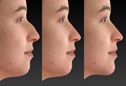 Simulador 3D de rinoplastia