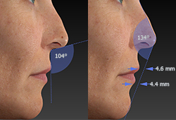 Simulador 3D de Rinoplastia