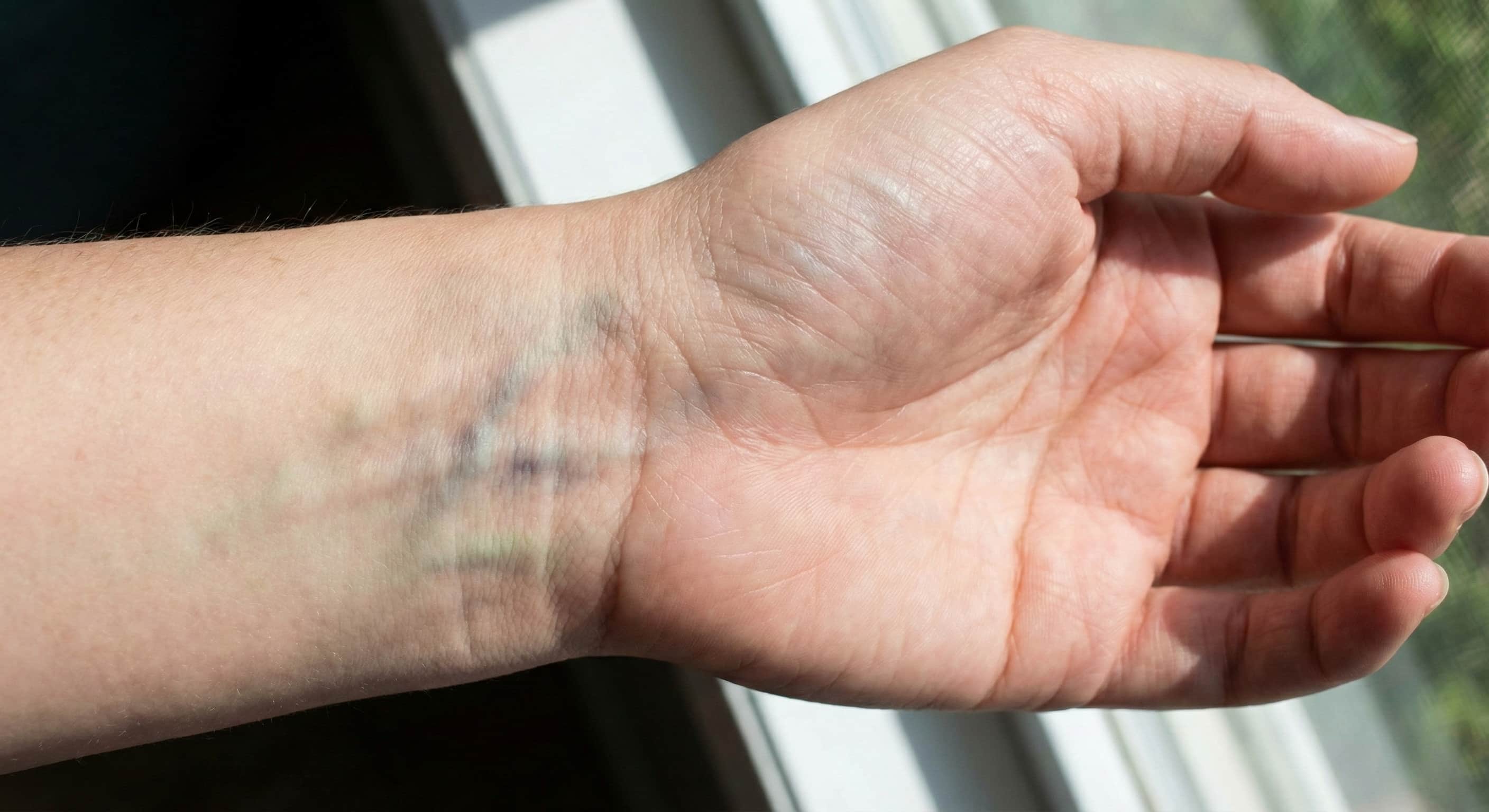 Imagen del test de las venas para determinar el tono de piel